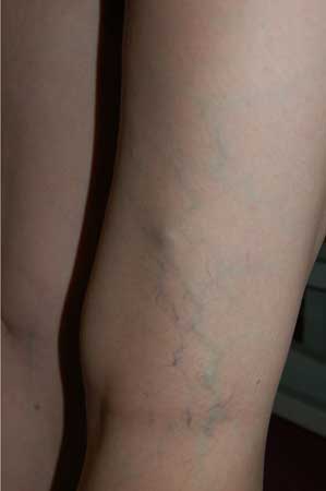 Reticular Veins Before Treatment